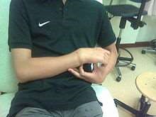 Colles fracture externally. Not an xray