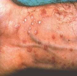lichen planus tongue