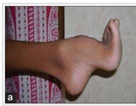 open access image of pes cavus