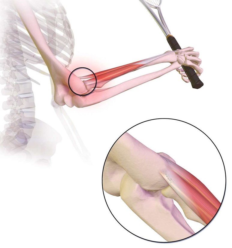 drawing of tennis elbow