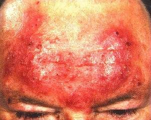 ROSACEA -ON FOREHEAD