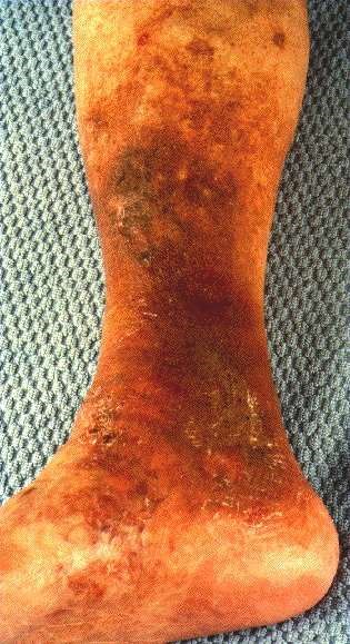 VARICOSE ECZEMA -ON LOWER LEG
