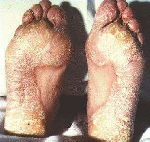 FOOT PSORIASIS -SHOWING HYPERKERATOSIS