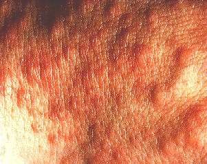 POLYMORPHIC LIGHT ERUPTION - CLOSE UP