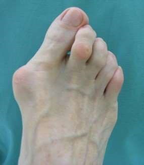 open access photo of hallux valgus