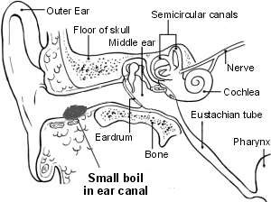Boil in the ear canal