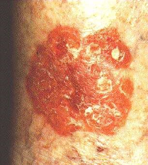 BOWEN'S DISEASE