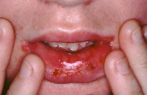 ORAL HERPES SIMPLEX(2)