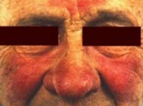 rosacea on nose, cheeks and forehead