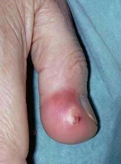 GOUT
